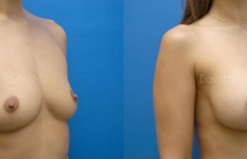Breast Augmentation Before and After | Sayah Institute