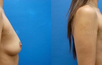 Breast Augmentation Before and After | Sayah Institute