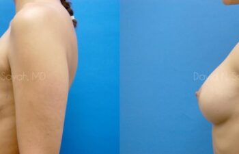 Breast Augmentation Before and After | Sayah Institute