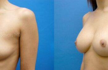Breast Augmentation Before and After | Sayah Institute