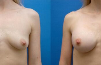 Breast Augmentation Before and After | Sayah Institute