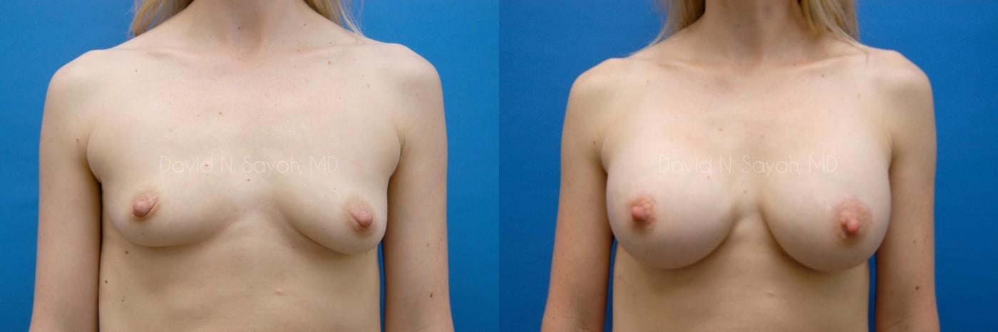 Breast Augmentation Before and After | Sayah Institute