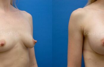 Breast Augmentation Before and After | Sayah Institute