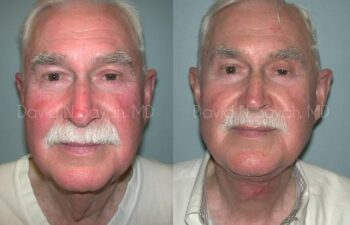 Neck Lift Before and After | Sayah Institute