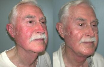 Neck Lift Before and After | Sayah Institute