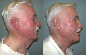 Neck Lift Before and After | Sayah Institute