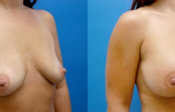 Breast Augmentation Before and After | Sayah Institute