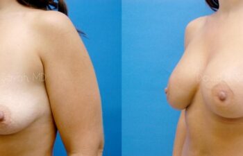 Breast Augmentation Before and After | Sayah Institute