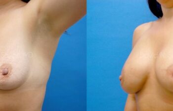 Breast Augmentation Before and After | Sayah Institute