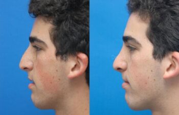 Rhinoplasty Before and After | Sayah Institute