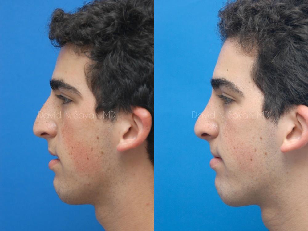 Rhinoplasty Before and After | Sayah Institute
