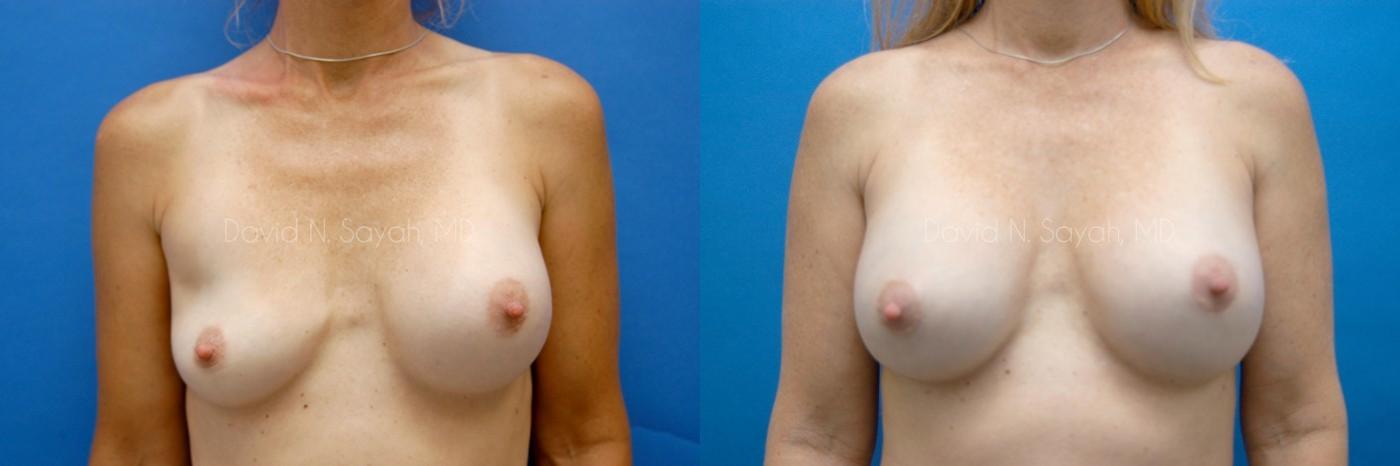 Breast Augmentation Before and After | Sayah Institute