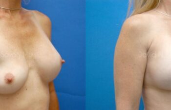 Breast Augmentation Before and After | Sayah Institute