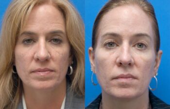 Eyelid Surgery Before and After | Sayah Institute