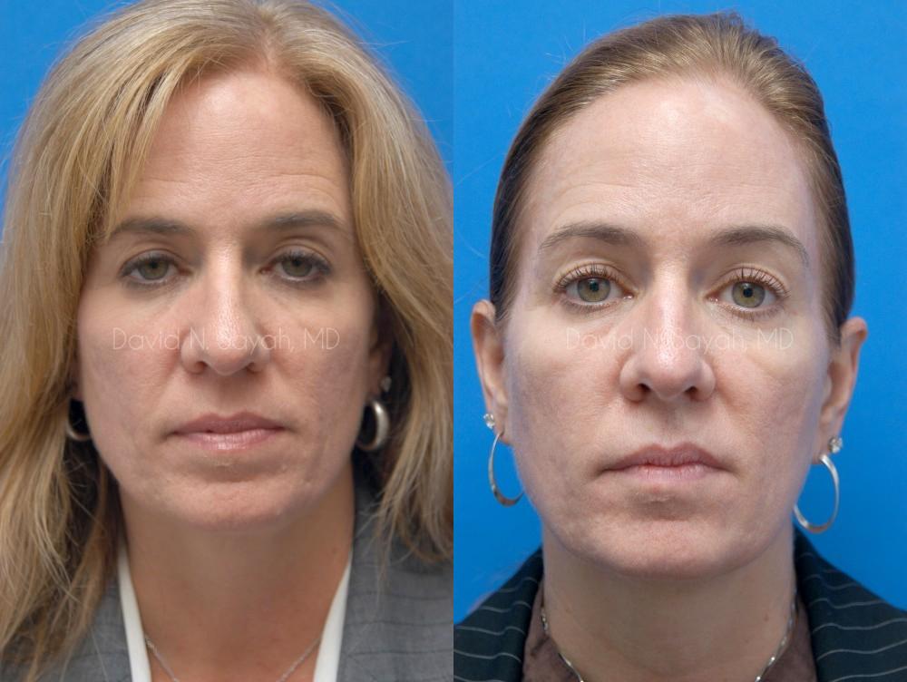 Eyelid Surgery Before and After | Sayah Institute