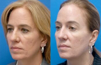 Eyelid Surgery Before and After | Sayah Institute