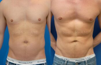 Liposuction Before and After | Sayah Institute