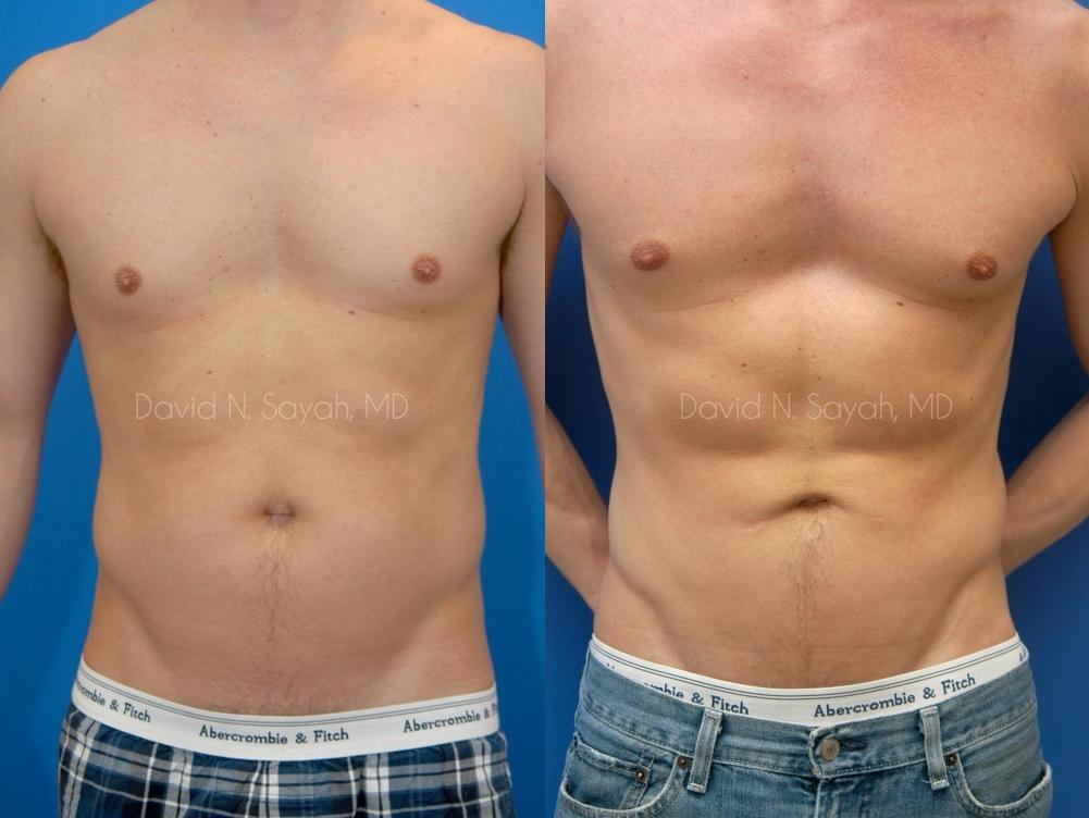 Liposuction Before and After | Sayah Institute