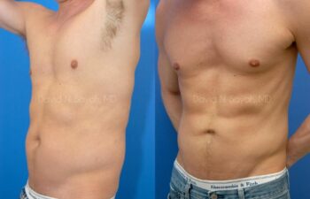 Liposuction Before and After | Sayah Institute