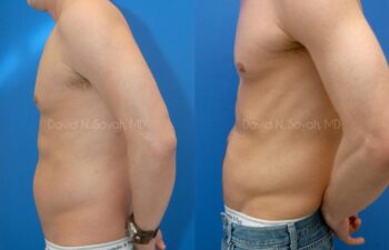 Liposuction Before and After | Sayah Institute