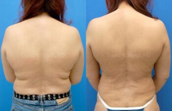 Liposuction Before and After | Sayah Institute