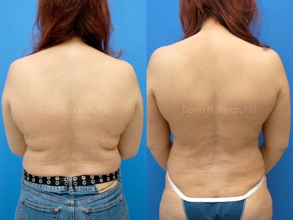 Liposuction Before and After | Sayah Institute