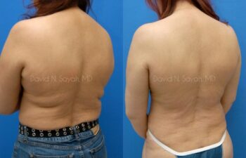 Liposuction Before and After | Sayah Institute