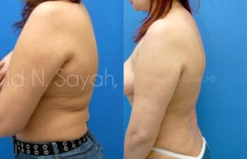 Liposuction Before and After | Sayah Institute