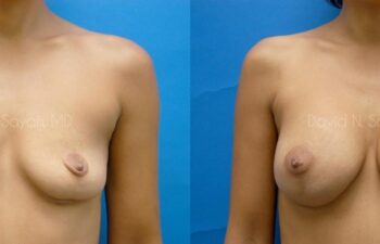 Breast Augmentation Before and After | Sayah Institute