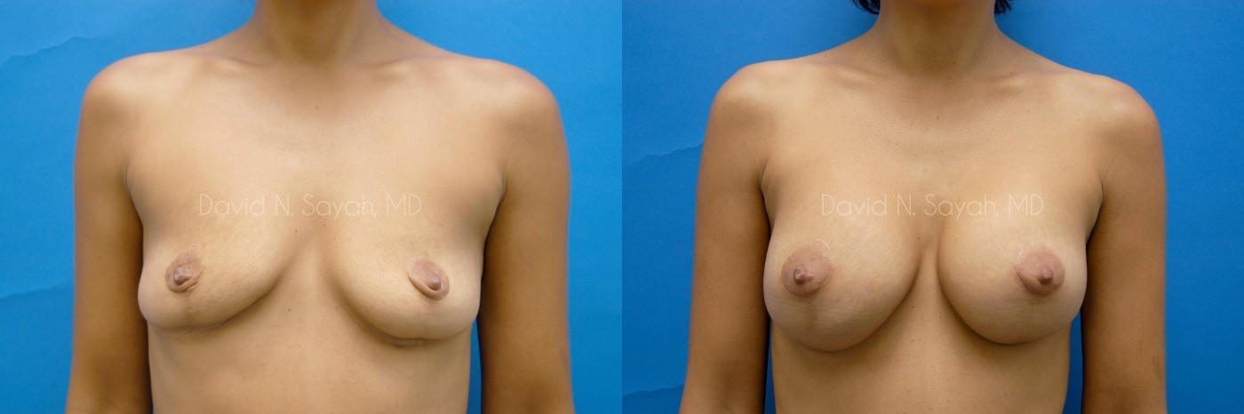 Breast Augmentation Before and After | Sayah Institute