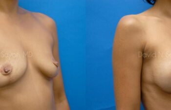Breast Augmentation Before and After | Sayah Institute
