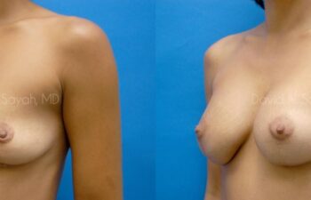 Breast Augmentation Before and After | Sayah Institute