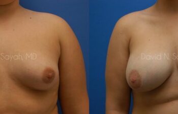 Breast Augmentation Before and After | Sayah Institute