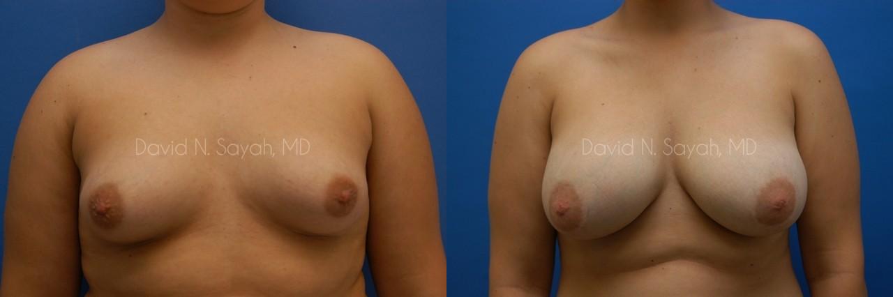 Breast Augmentation Before and After | Sayah Institute