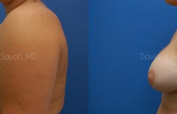 Breast Augmentation Before and After | Sayah Institute