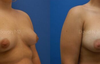 Breast Augmentation Before and After | Sayah Institute