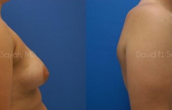 Breast Augmentation Before and After | Sayah Institute