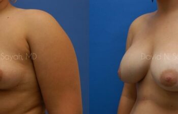 Breast Augmentation Before and After | Sayah Institute