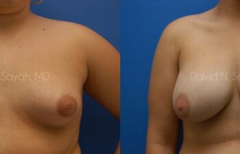 Breast Augmentation Before and After | Sayah Institute