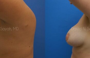 Breast Augmentation Before and After | Sayah Institute