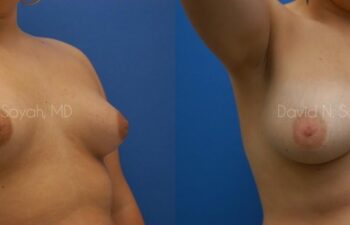 Breast Augmentation Before and After | Sayah Institute