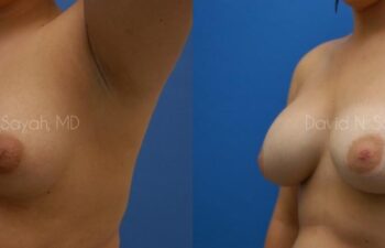Breast Augmentation Before and After | Sayah Institute