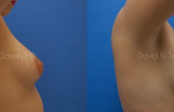 Breast Augmentation Before and After | Sayah Institute