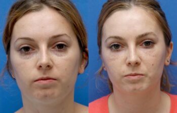 Fat Injection Face Before and After | Sayah Institute