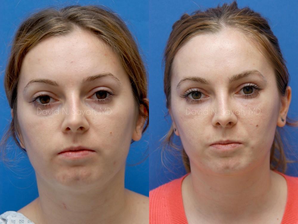 Fat Injection Face Before and After | Sayah Institute