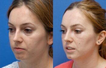 Fat Injection Face Before and After | Sayah Institute