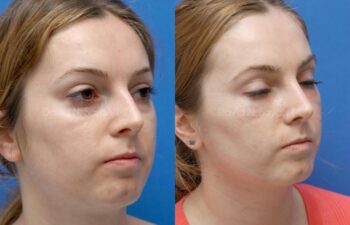 Fat Injection Face Before and After | Sayah Institute