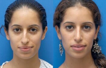 Rhinoplasty Before and After | Sayah Institute