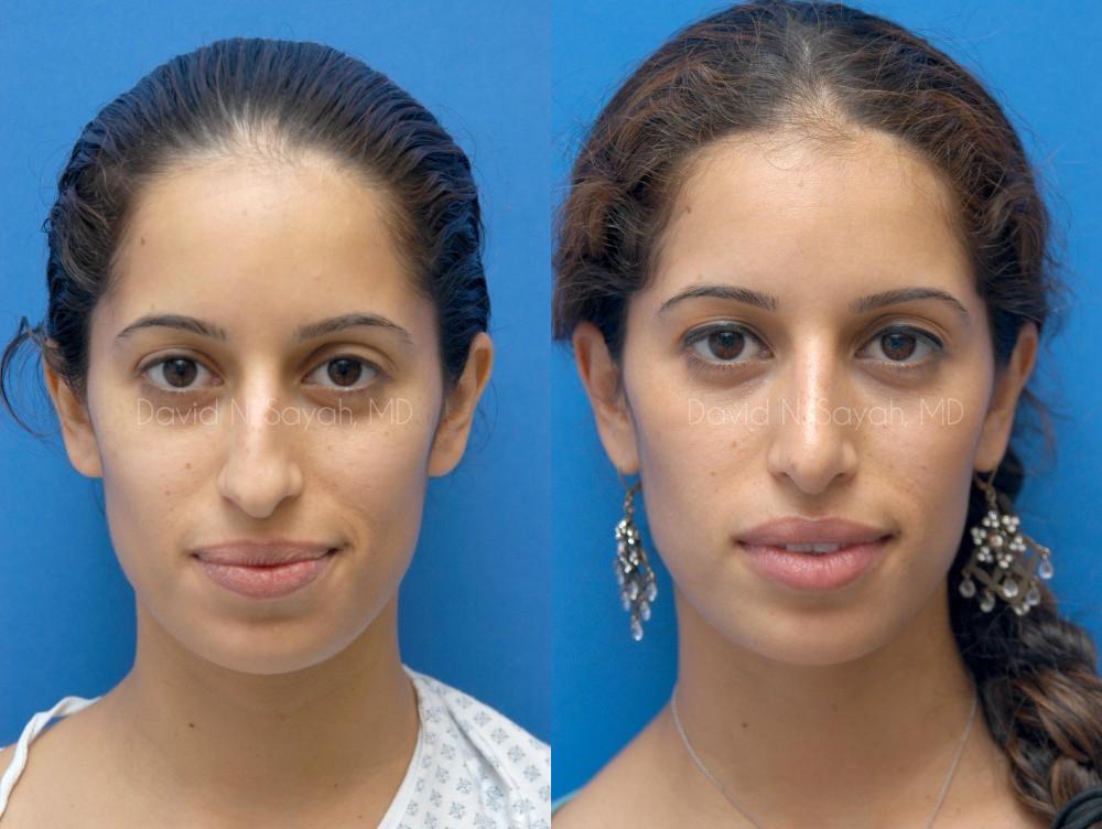Rhinoplasty Before and After | Sayah Institute