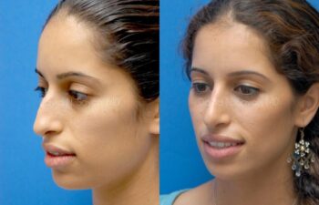 Rhinoplasty Before and After | Sayah Institute